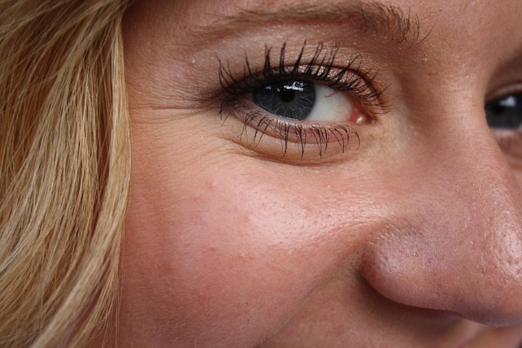 Cura cicatrici con creme e filler dermici